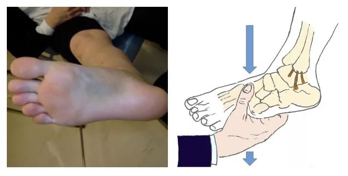 4,临床诊断因中足,后足有强有力的肌腱及韧带保护,且跖跗关节的背侧是