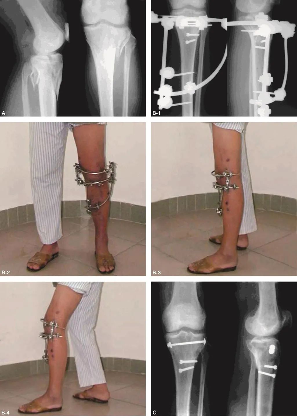 外固定器有哪些实用干货 ｜ 膝关节外固定器使用技巧_https://www.jmylbn.com_新闻资讯_第7张