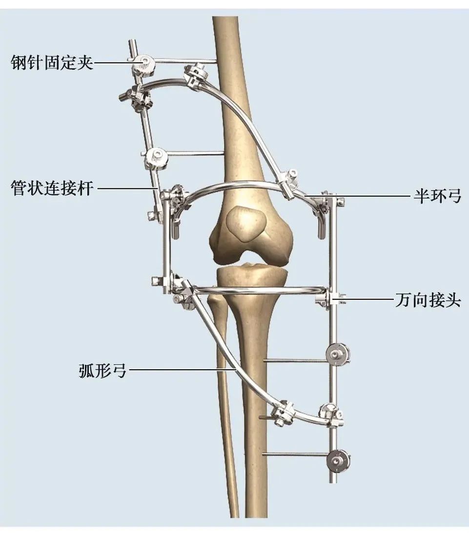 外固定器有哪些实用干货 ｜ 膝关节外固定器使用技巧_https://www.jmylbn.com_新闻资讯_第3张