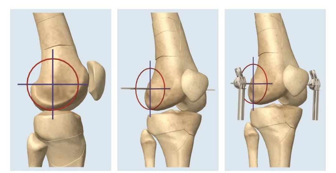 外固定器有哪些实用干货 ｜ 膝关节外固定器使用技巧_https://www.jmylbn.com_新闻资讯_第6张