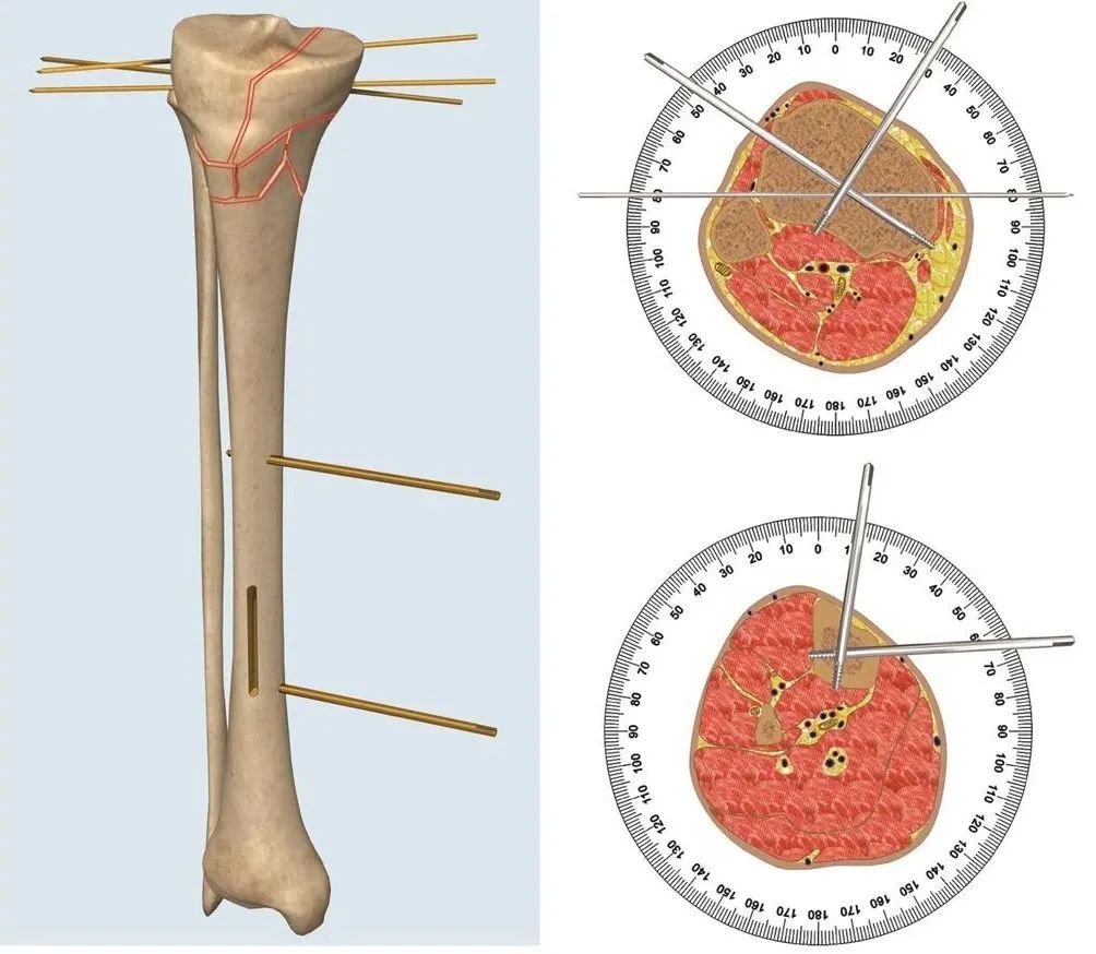 外固定器有哪些实用干货 ｜ 膝关节外固定器使用技巧_https://www.jmylbn.com_新闻资讯_第4张