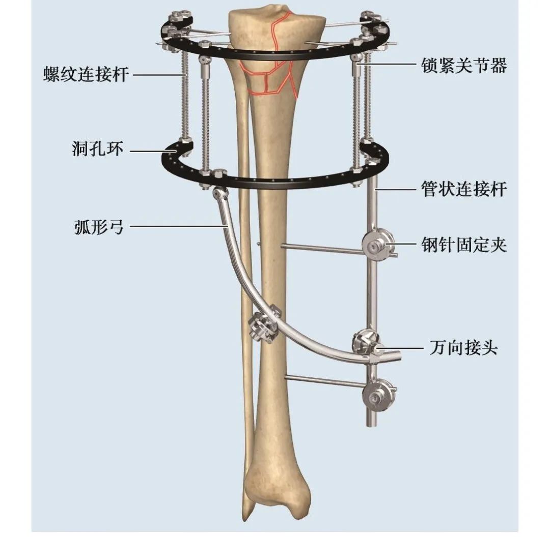 外固定器有哪些实用干货 ｜ 膝关节外固定器使用技巧_https://www.jmylbn.com_新闻资讯_第1张