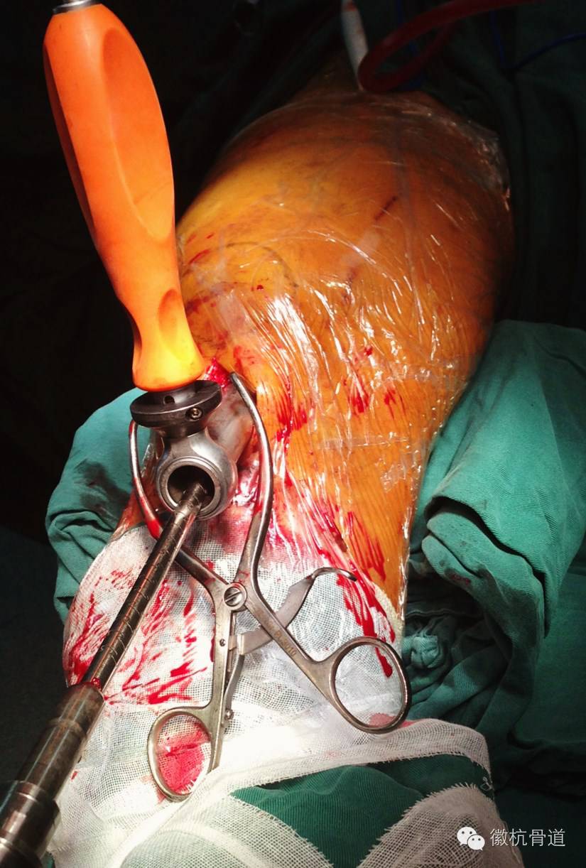 股骨干骨折髓内钉固定复位技巧 - 上海开为医药科技有限公司--创伤