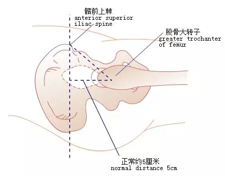 海氏三角解剖结构图片