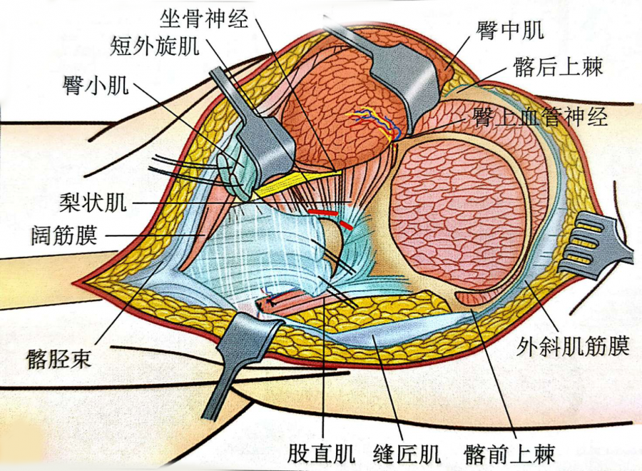 髋臼切迹图片