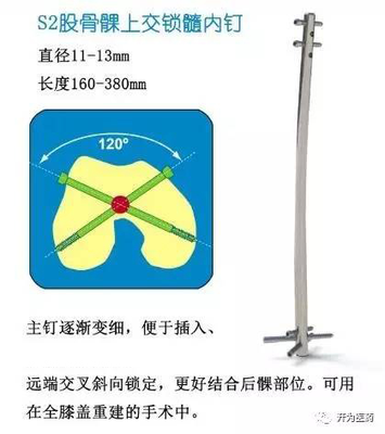 S2股骨髁上交锁髓内钉