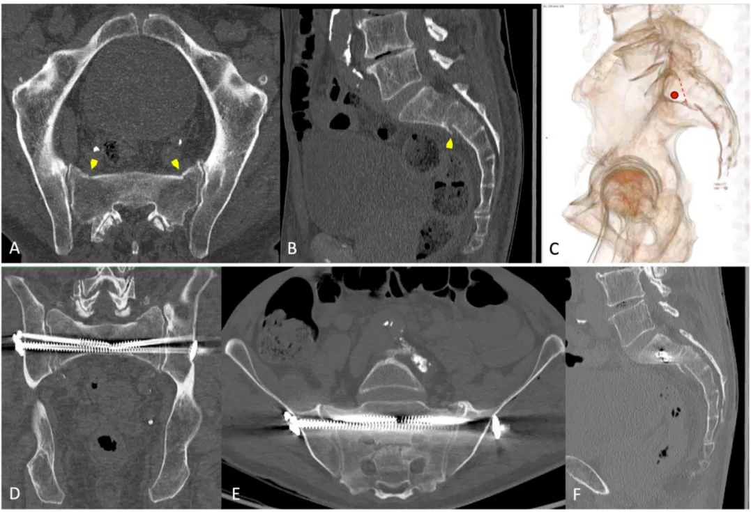 早读| 如何打好骶髂螺钉？本文手把手教会你！ - 上海开为医药科技有限公司--创伤、肢体矫形技术解决方案的专业服务商