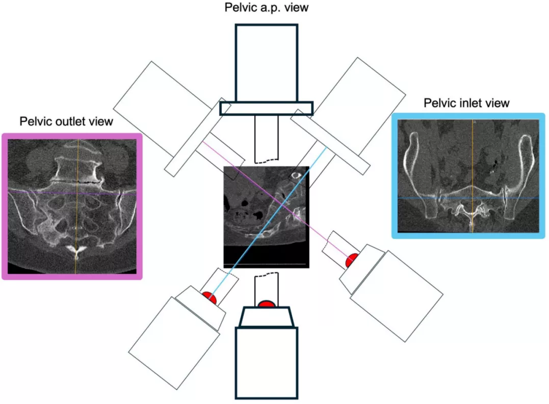 早读| 如何打好骶髂螺钉？本文手把手教会你！ - 上海开为医药科技有限公司--创伤、肢体矫形技术解决方案的专业服务商