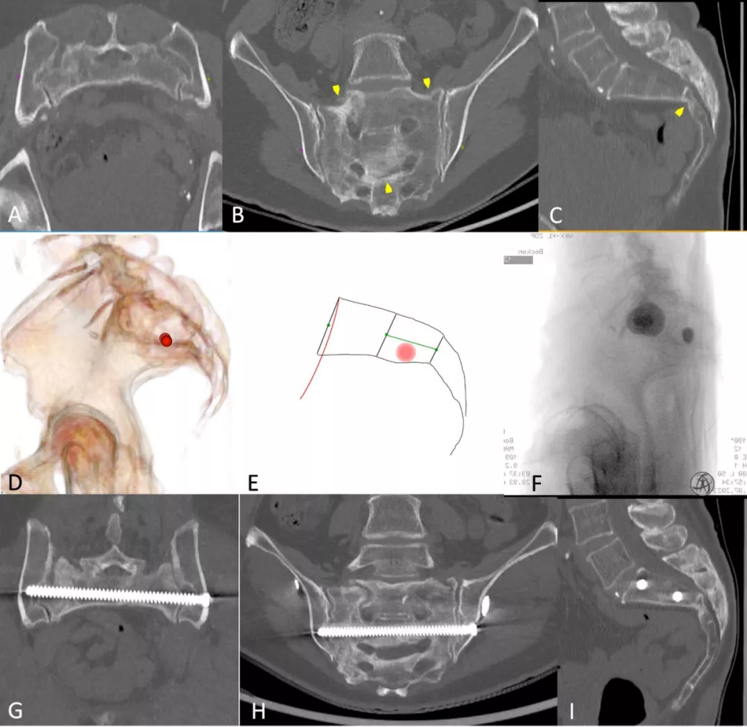 早读| 如何打好骶髂螺钉？本文手把手教会你！ - 上海开为医药科技有限公司--创伤、肢体矫形技术解决方案的专业服务商