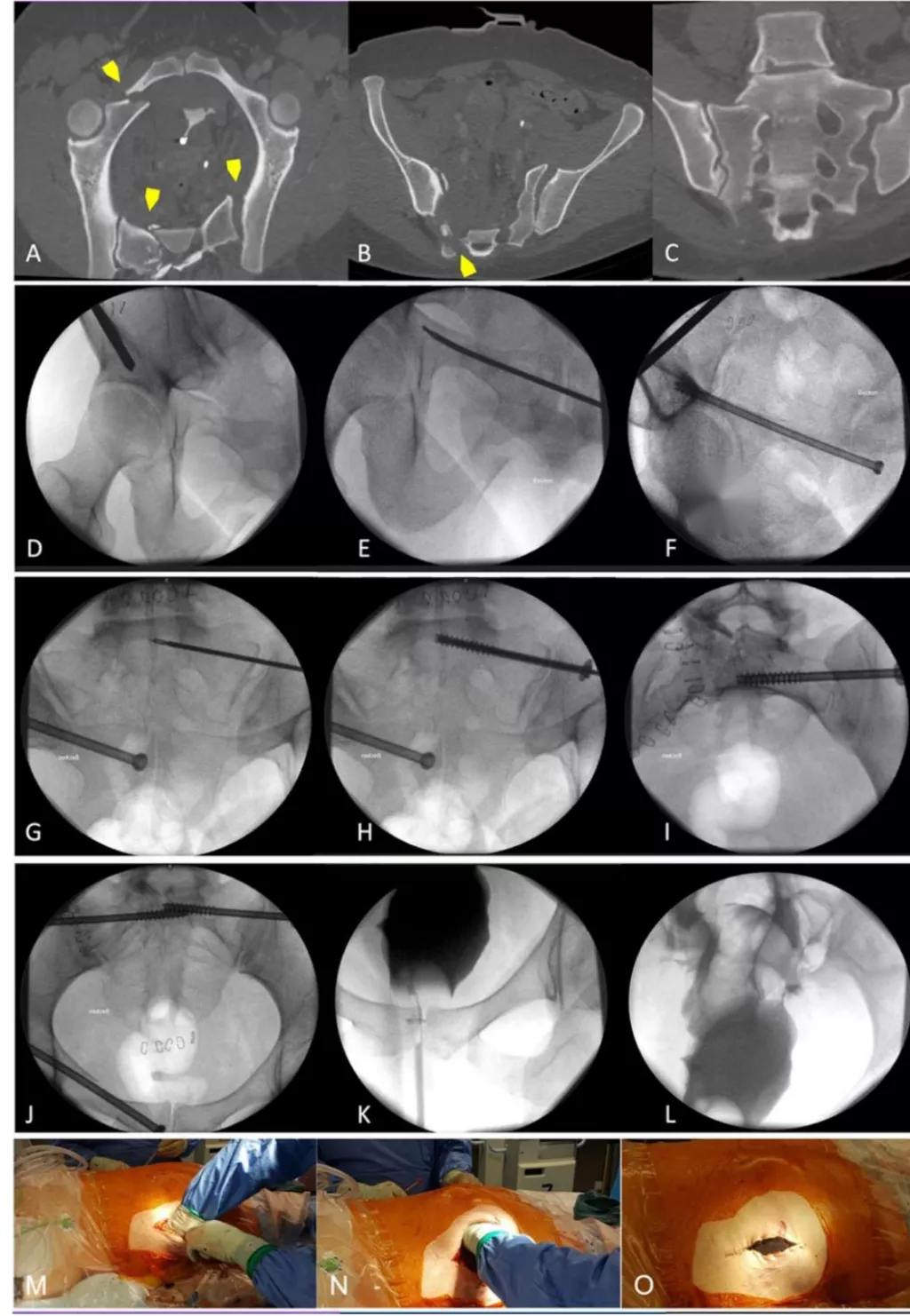 早读| 如何打好骶髂螺钉？本文手把手教会你！ - 上海开为医药科技有限公司--创伤、肢体矫形技术解决方案的专业服务商