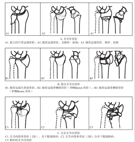 图文详解:桡骨远端骨折手法复位技术