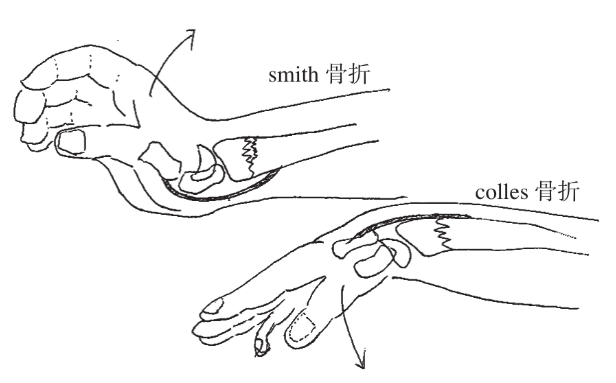 图文详解:桡骨远端骨折手法复位技术