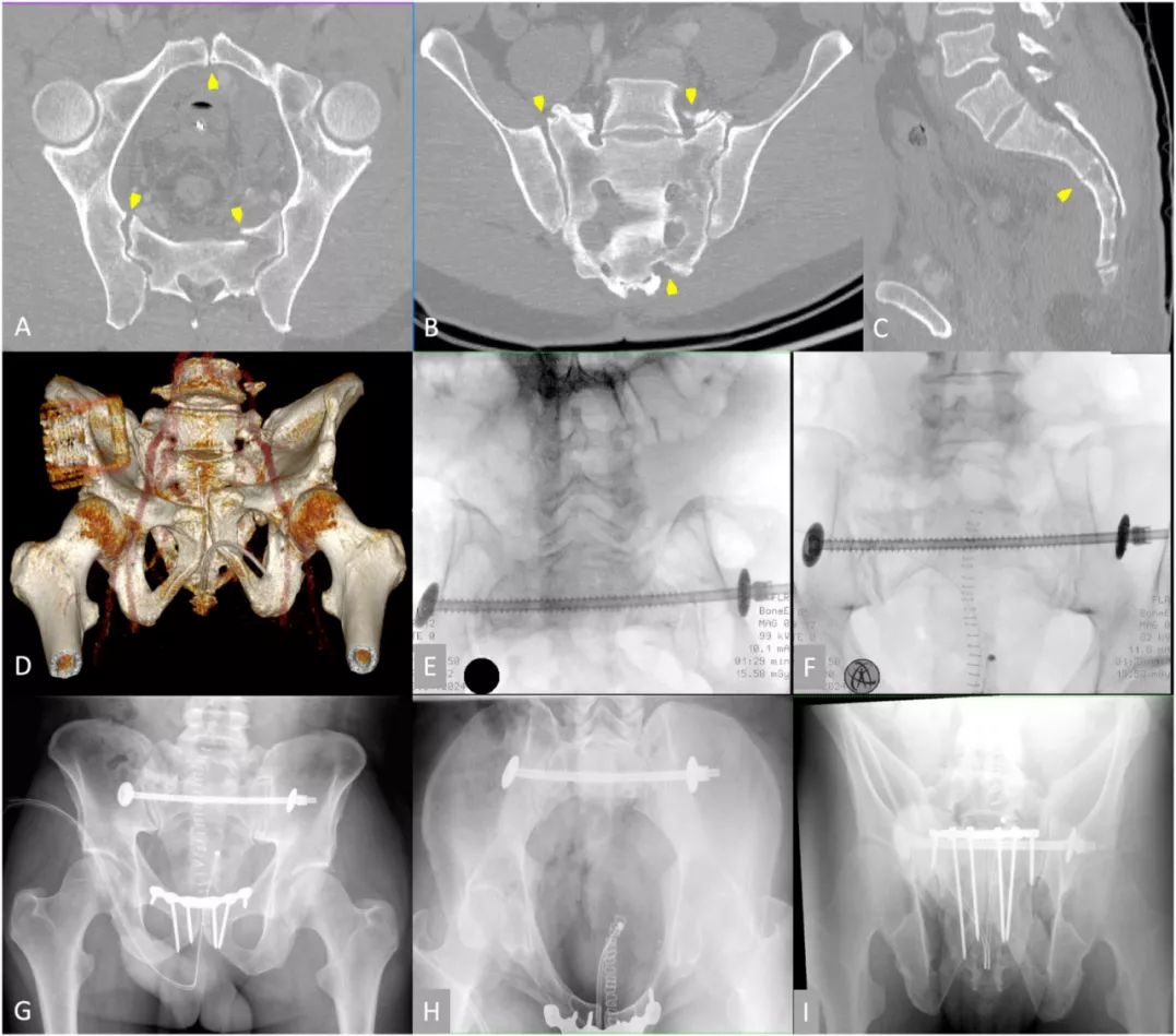 早读| 如何打好骶髂螺钉？本文手把手教会你！ - 上海开为医药科技有限公司--创伤、肢体矫形技术解决方案的专业服务商