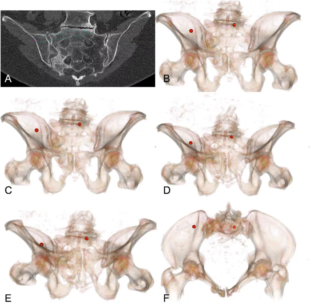 早读| 如何打好骶髂螺钉？本文手把手教会你！ - 上海开为医药科技有限公司--创伤、肢体矫形技术解决方案的专业服务商
