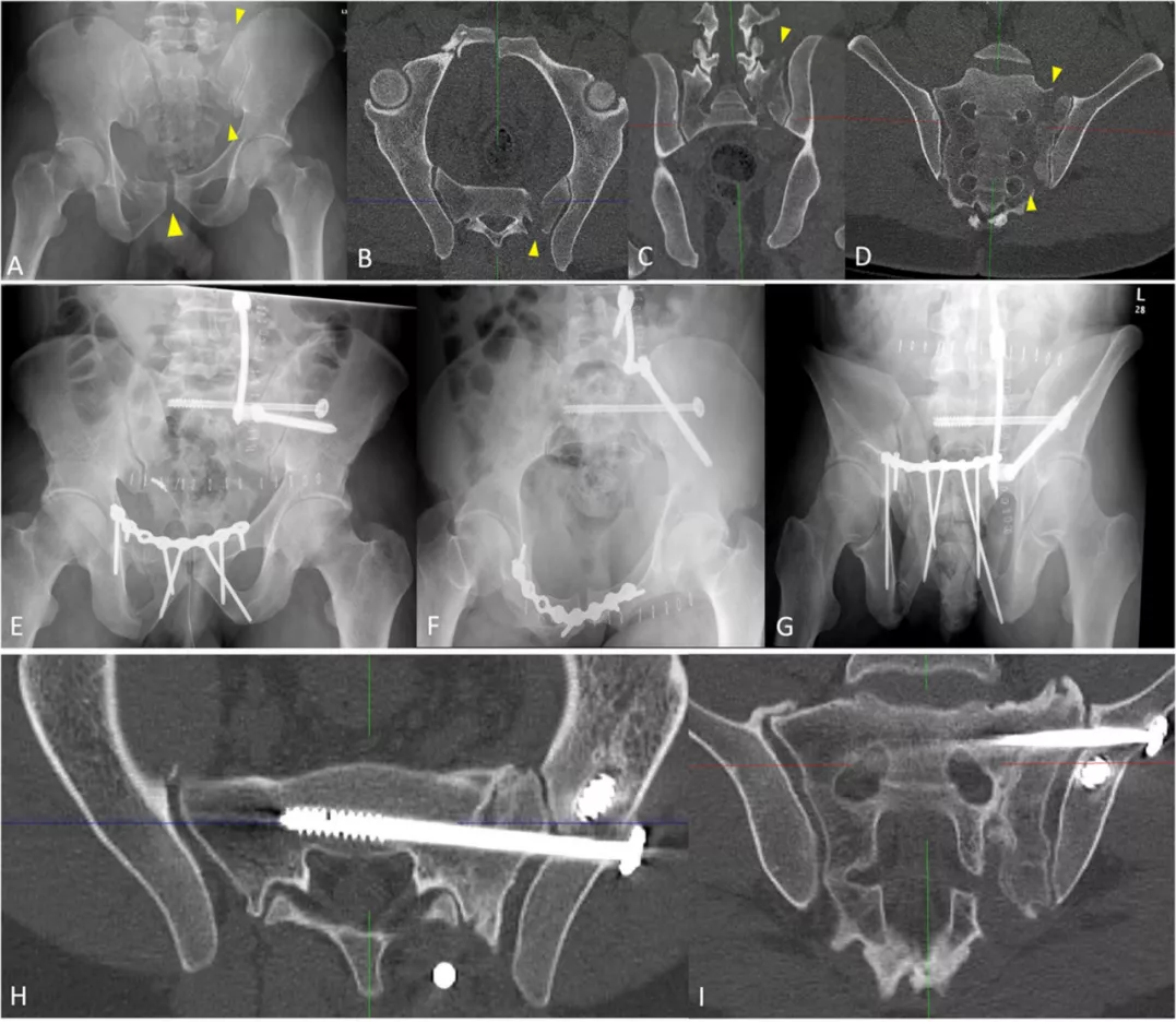 早读| 如何打好骶髂螺钉？本文手把手教会你！ - 上海开为医药科技有限公司--创伤、肢体矫形技术解决方案的专业服务商