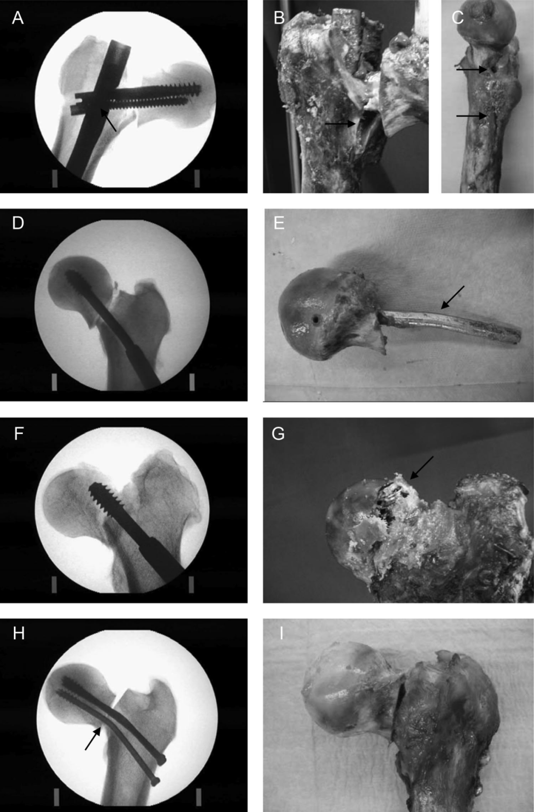 生物钉是什么材料荐读 ｜ 不稳定型股骨颈骨折固定装置的生物力学比较分析：Intertan与空心螺钉、DHS选哪个_https://www.jmylbn.com_新闻资讯_第9张