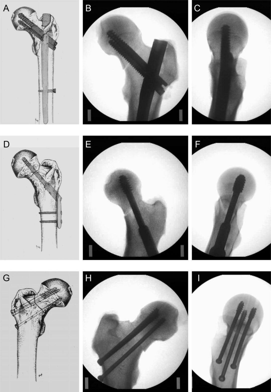 生物钉是什么材料荐读 ｜ 不稳定型股骨颈骨折固定装置的生物力学比较分析：Intertan与空心螺钉、DHS选哪个_https://www.jmylbn.com_新闻资讯_第3张