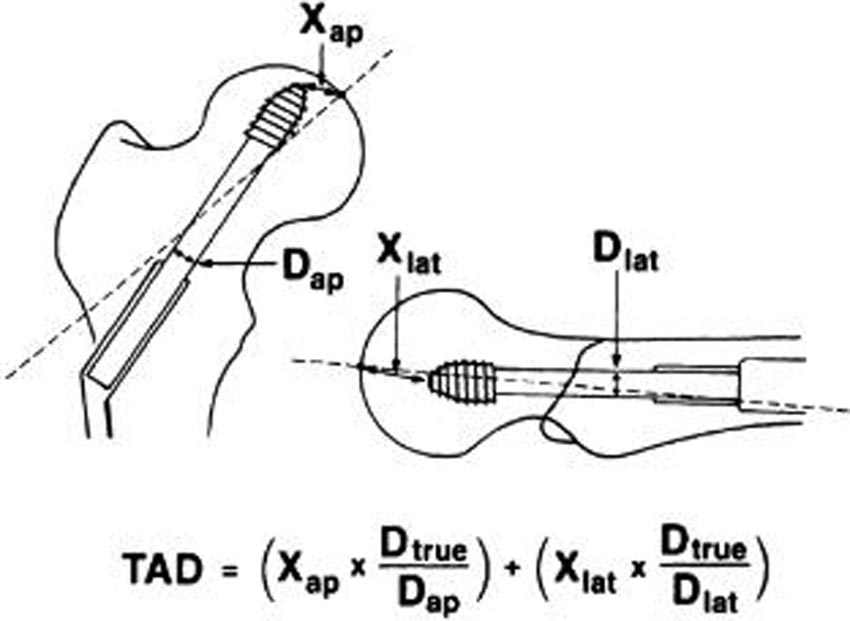 生物钉是什么材料荐读 ｜ 不稳定型股骨颈骨折固定装置的生物力学比较分析：Intertan与空心螺钉、DHS选哪个_https://www.jmylbn.com_新闻资讯_第4张
