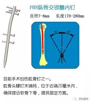 PHN肱骨交锁髓内钉