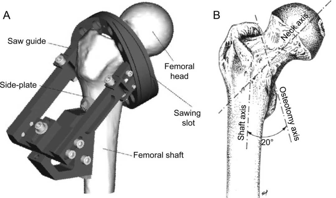 生物钉是什么材料荐读 ｜ 不稳定型股骨颈骨折固定装置的生物力学比较分析：Intertan与空心螺钉、DHS选哪个_https://www.jmylbn.com_新闻资讯_第2张