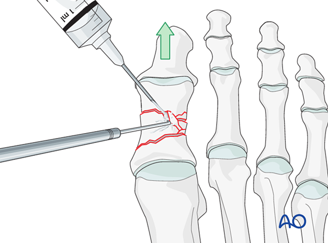 关节钳怎么用近节拇趾关节外骨折的钢板固定（AO指南）_https://www.jmylbn.com_新闻资讯_第8张