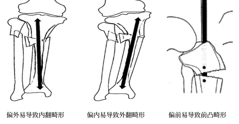 骨科技巧 | 胫骨骨折髓内钉治疗,如何选择正确的进针点?