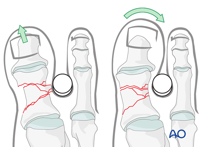 关节钳怎么用近节拇趾关节外骨折的钢板固定（AO指南）_https://www.jmylbn.com_新闻资讯_第7张