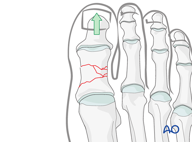 关节钳怎么用近节拇趾关节外骨折的钢板固定（AO指南）_https://www.jmylbn.com_新闻资讯_第6张