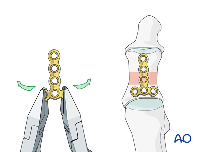 关节钳怎么用近节拇趾关节外骨折的钢板固定（AO指南）_https://www.jmylbn.com_新闻资讯_第12张