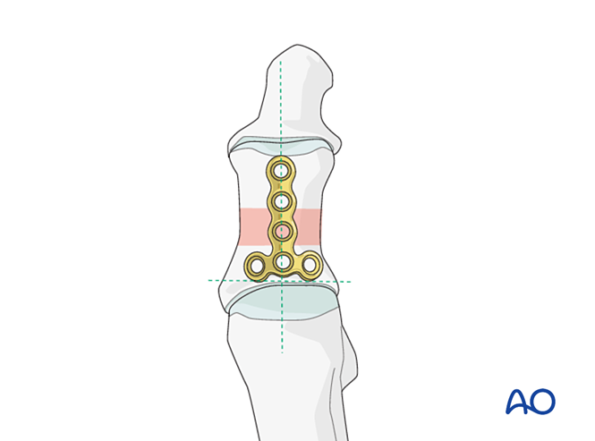 关节钳怎么用近节拇趾关节外骨折的钢板固定（AO指南）_https://www.jmylbn.com_新闻资讯_第13张