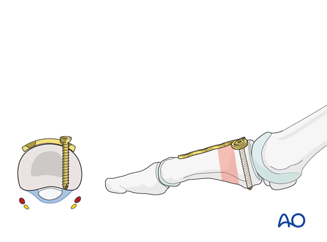 关节钳怎么用近节拇趾关节外骨折的钢板固定（AO指南）_https://www.jmylbn.com_新闻资讯_第14张