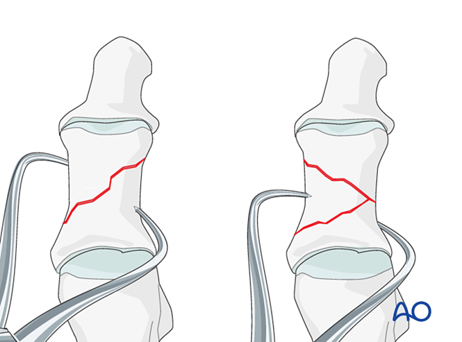 关节钳怎么用近节拇趾关节外骨折的钢板固定（AO指南）_https://www.jmylbn.com_新闻资讯_第9张