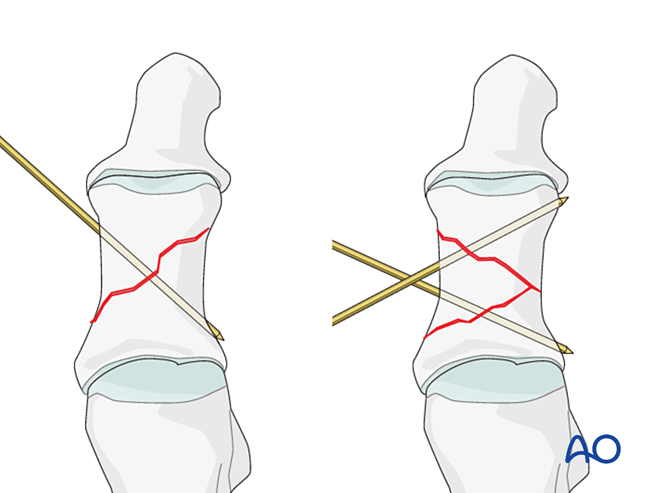 关节钳怎么用近节拇趾关节外骨折的钢板固定（AO指南）_https://www.jmylbn.com_新闻资讯_第10张