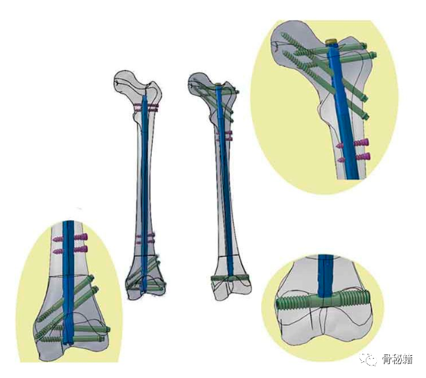骨髓钉的过程图片图片