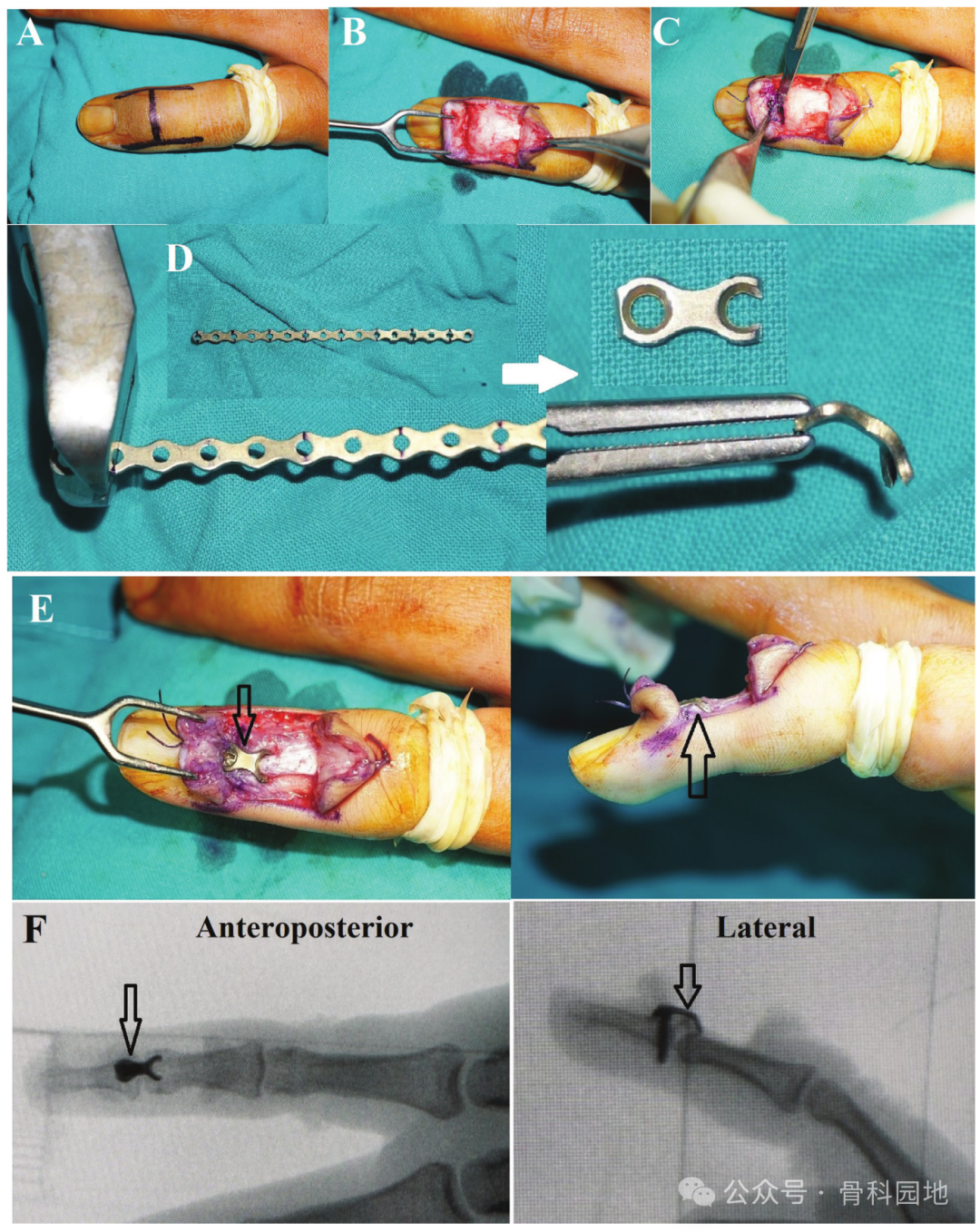 锤状指铆钉手术示意图图片