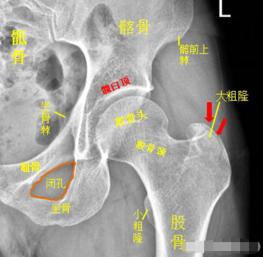 小粗隆骨折图片解剖图片