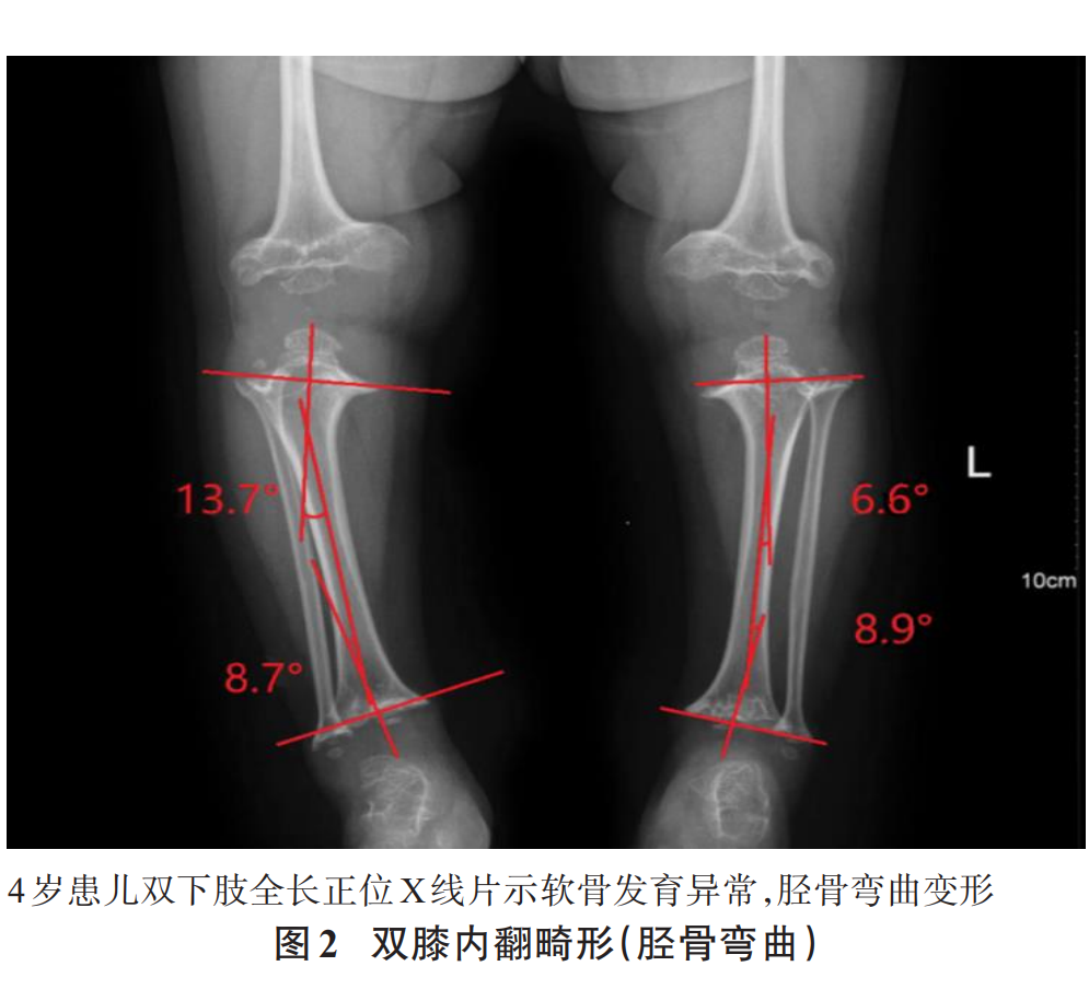 病例报道｜Ilizarov技术治疗软骨发育不全下肢畸形的研究进展- 上海开为医药科技有限公司--创伤、肢体矫形技术解决方案的专业服务商