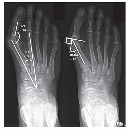 拇外翻角度测量方法图片