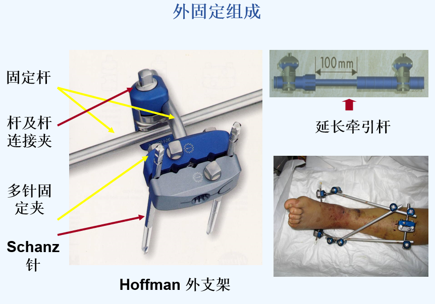 伊利扎诺夫外固定架图片