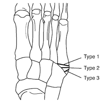3分钟get:第五跖骨基底部骨折的技术要点,看这篇就够了!