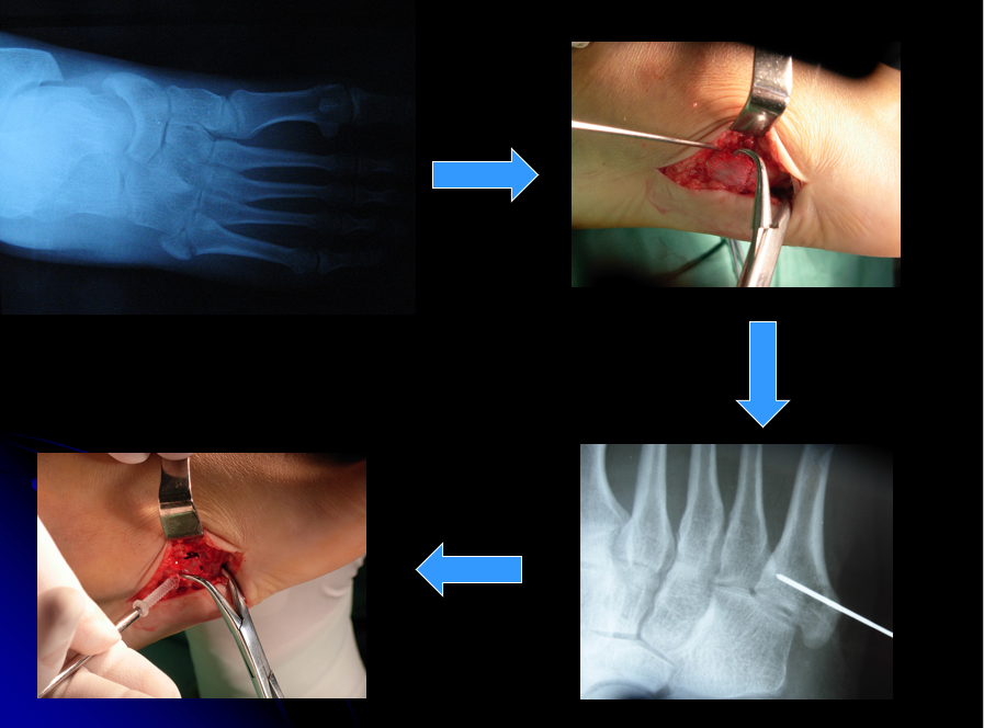 手术方法适用于第五跖骨基底部i区和ii区骨折(移位﹥2毫米)或者伴有小