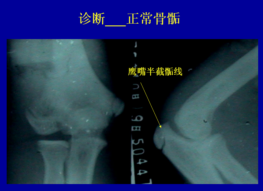 尺骨鹰嘴骨骺骨折图解图片