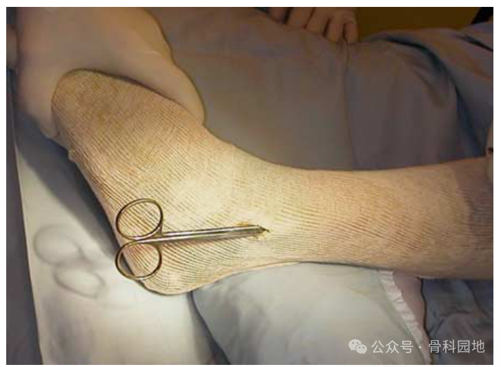 只有想不到没有做不到 | 1cm切口,切开复位钢板内固定外踝骨折、桡骨远端骨折 - 上海开为医药科技有限公司--创伤、肢体矫形技术解决方案的专业服务商