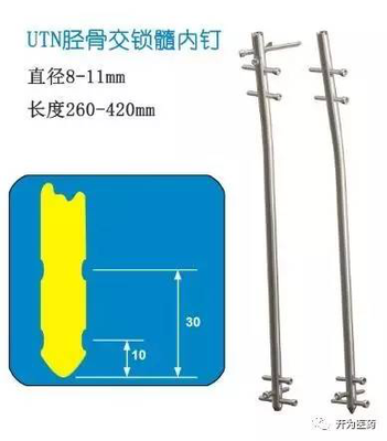 UTN胫骨交锁髓内钉
