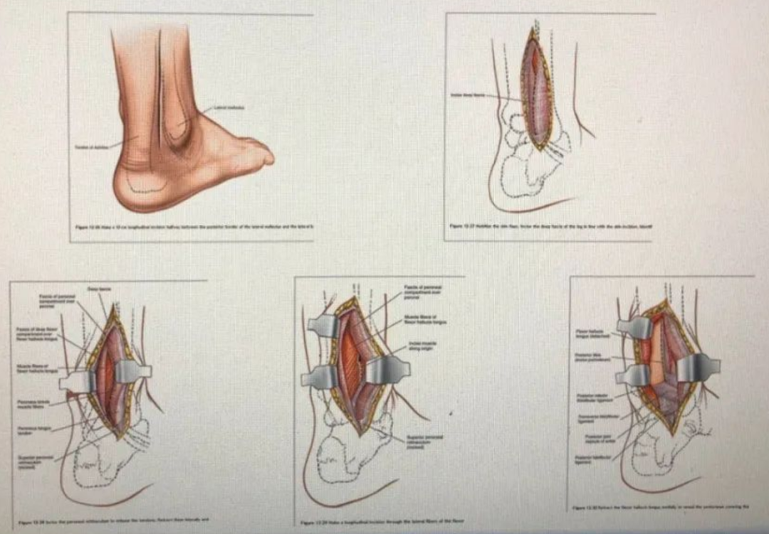 踝关节后内侧入路图谱图片