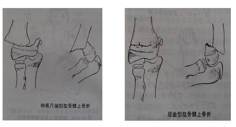 骨科精读 | 小儿肱骨髁上骨折的复位及手术技巧,建议收藏! - 上海开为医药科技有限公司--创伤、肢体矫形技术解决方案的专业服务商