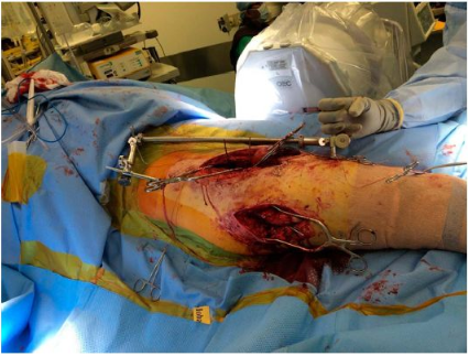 青年股骨颈骨折的复位技术 - 上海开为医药科技有限公司--创伤,肢体