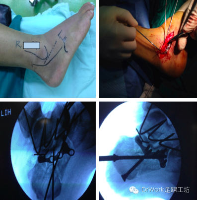 跟骨骨折微創治療足踝圓桌003