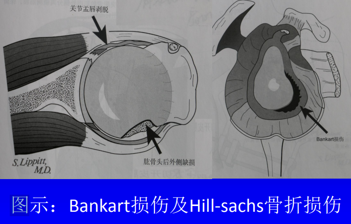 3分钟Get：Bankart损伤的技术要点，看这篇就够了！ - 上海开为医药科技
