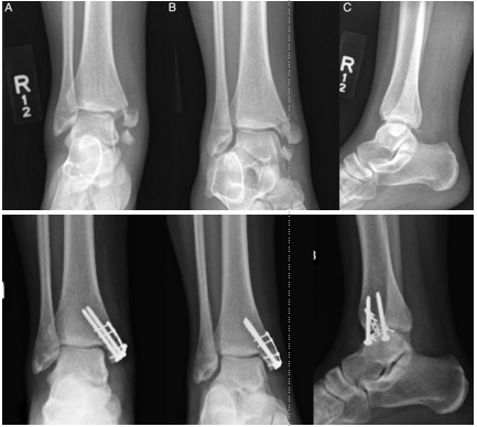早读图文并茂一文详解内踝骨折的治疗方法